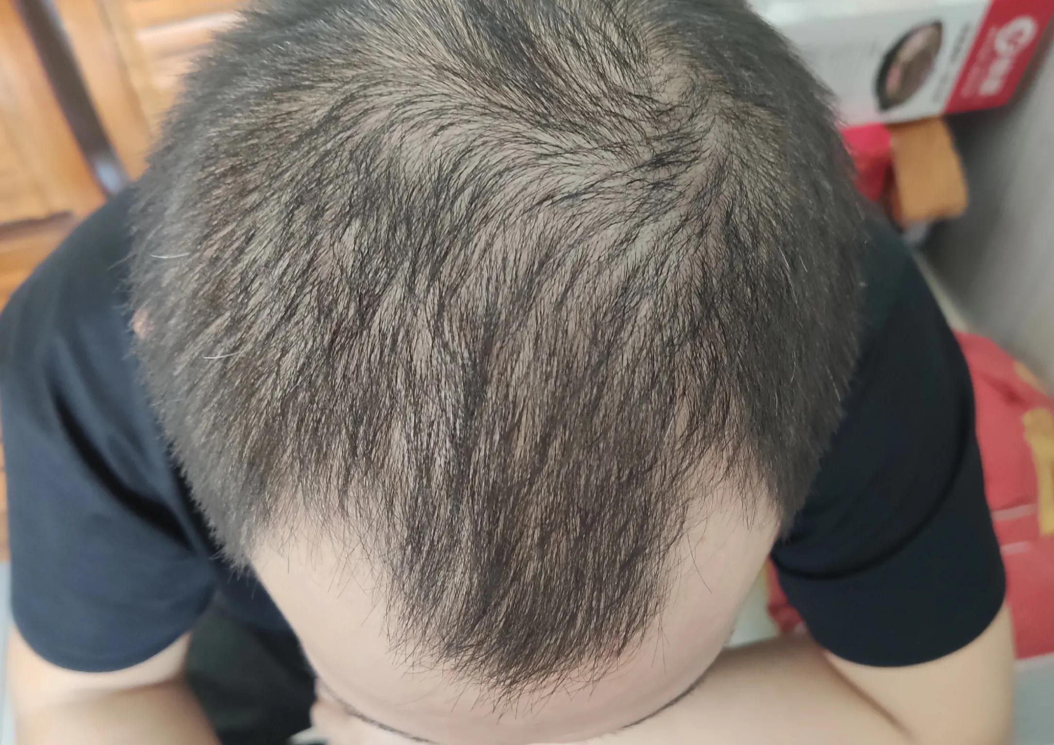 脱发育发什么产品好,什么脱发产品效果好