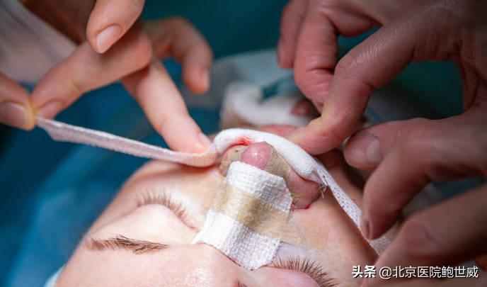 青春期驼峰鼻怎么自然矫正,驼峰鼻怎么自己矫正中学生