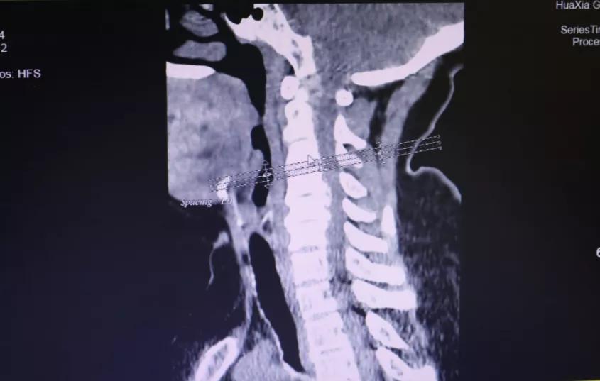 手痛手麻手指无力真相竟是颈椎病,颈椎病手麻手指有针刺感