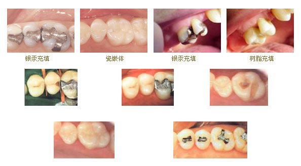 刚补的牙出现问题再去修要钱吗,刚补完牙齿感觉牙痛