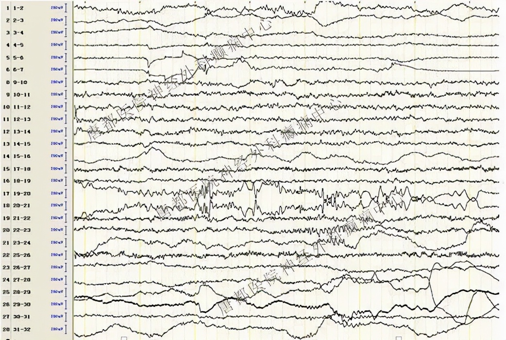 唐都医院癫痫手术能不能根治癫痫,唐都医院神经外科癫痫