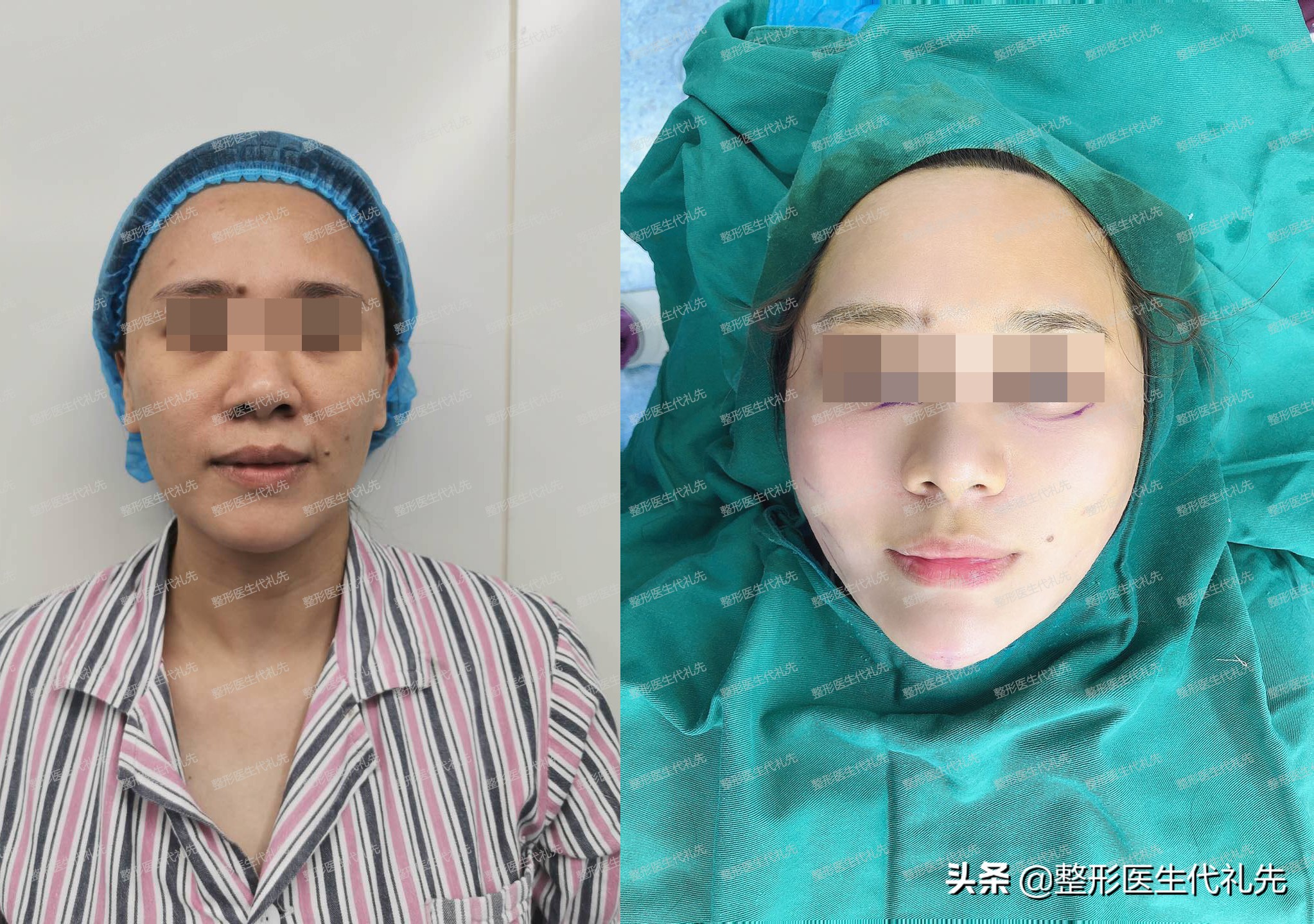 做脸部线雕埋线注意什么,面部线雕消肿的最佳方法