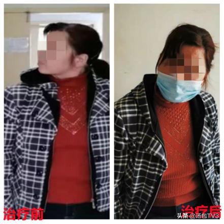 美容神器肉毒毒素“扶正”歪了一年的脖子病因竟是痉挛性斜颈