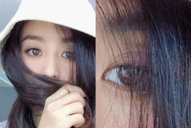 赵丽颖眼睛肿是怎么回事,赵丽颖眼睛长麦粒肿是因为拍戏吗