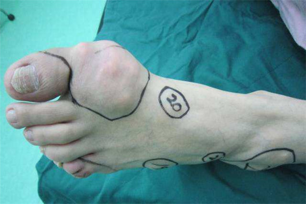 60多岁痛风有痛风石吃什么药,痛风十多年没长痛风石是什么原因