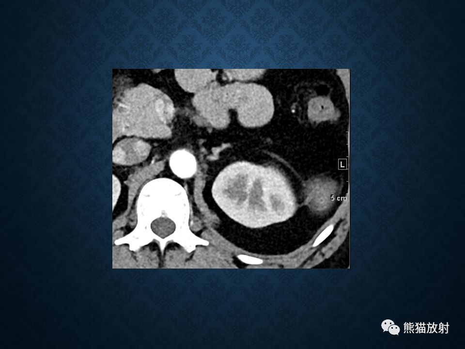 纵隔和肾上腺恶性肿瘤,纵隔性肿瘤位置图
