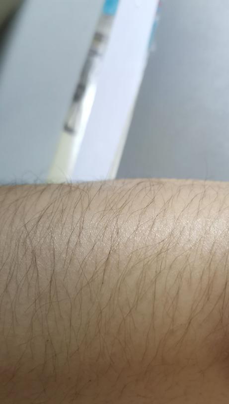 月经推迟体毛多是怎么回事,姨妈正常但是体毛多是什么原因