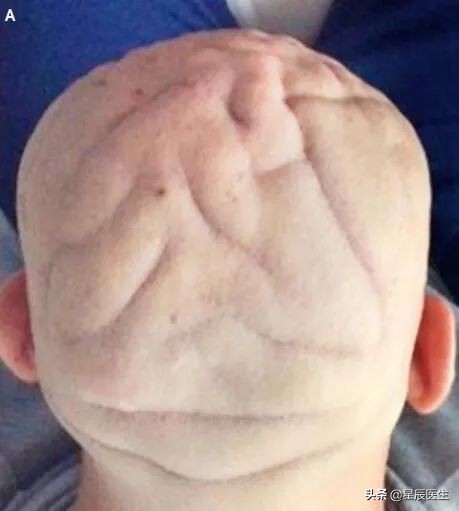 头皮上有蚊爬样感觉是怎么回事,头皮像蚊子叮过一样的包