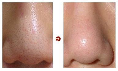 美容微针祛痘印,微针改善毛孔痘印做几次有效果