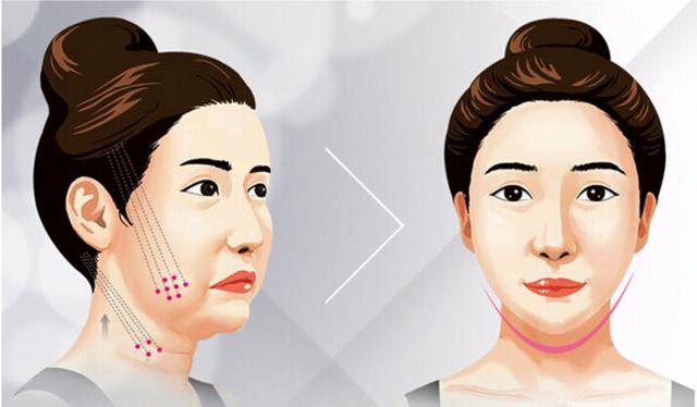 线雕提升如何通过特殊的布线思路将颧骨降低？