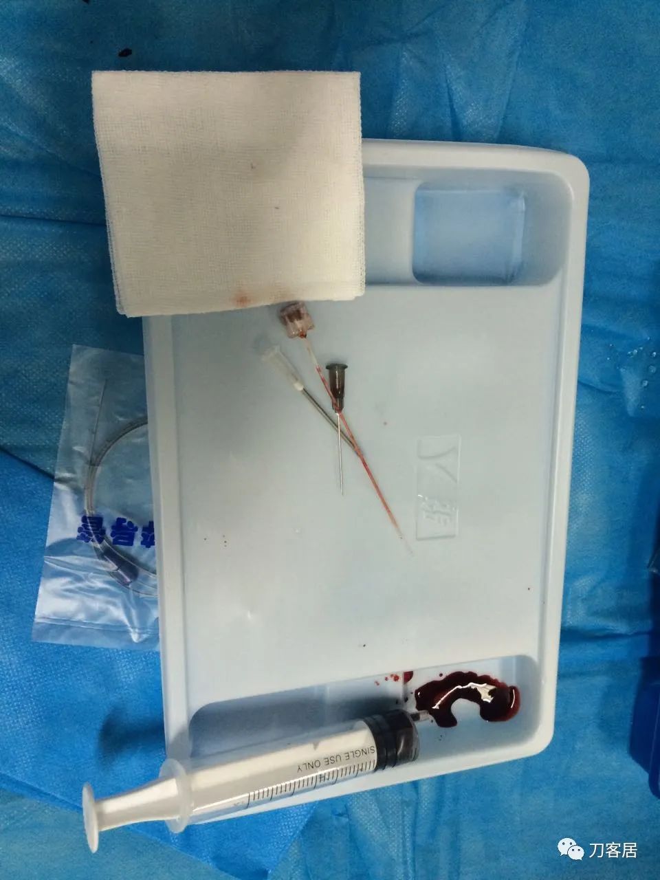 腰椎手术切掉棘突,腰突微创后出血肿