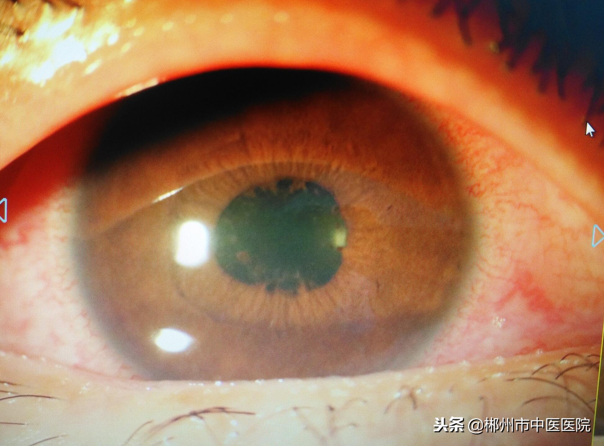 青光眼是不是红眼病,得了红眼病很容易得青光眼吗