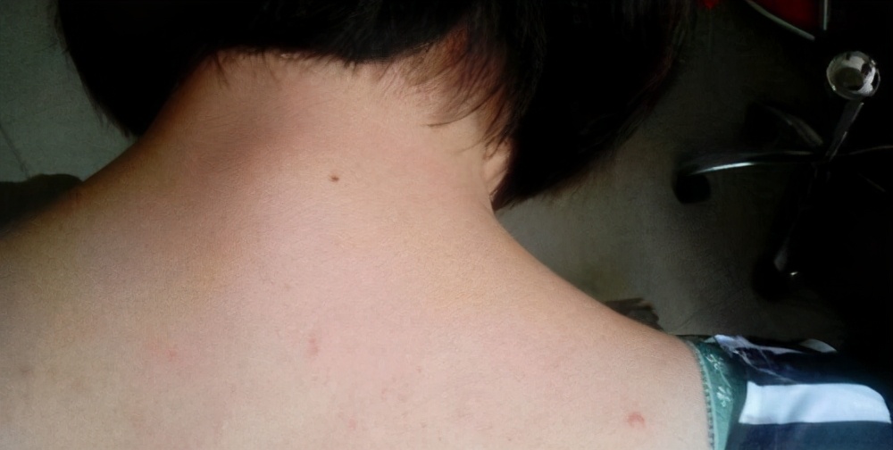 胸前背后过敏长痘痘怎么解决,胸前背后下巴长痘痘是什么原因