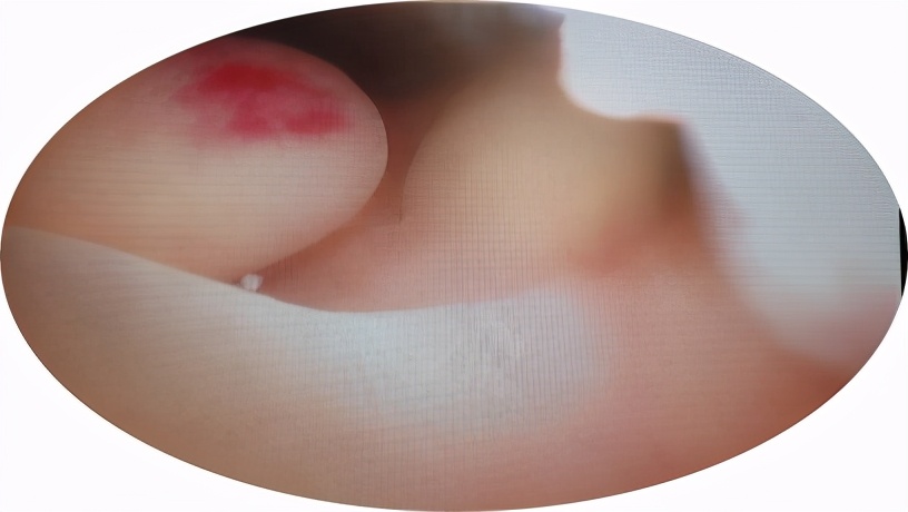 子宫内膜息肉是怎么回事呢,子宫内膜息肉是怎么引起