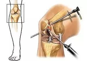 磁共振检查出来膝关节积液正常吗,外伤引起的膝关节积液磁共振