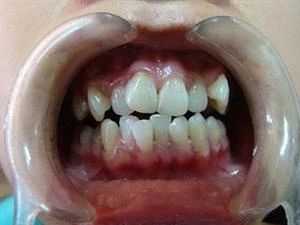 矫正牙齿为什么牙齿有牙缝了,12岁儿童门牙中间有缝隙怎么矫正