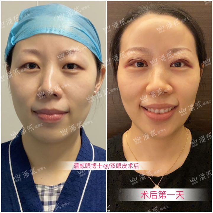 原来双眼皮不好看有必要继续割吗,割双眼皮是不是越修复越难看