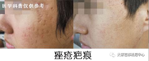 脸上长疮后留下疤痕怎么去除,疮疤怎么彻底消除