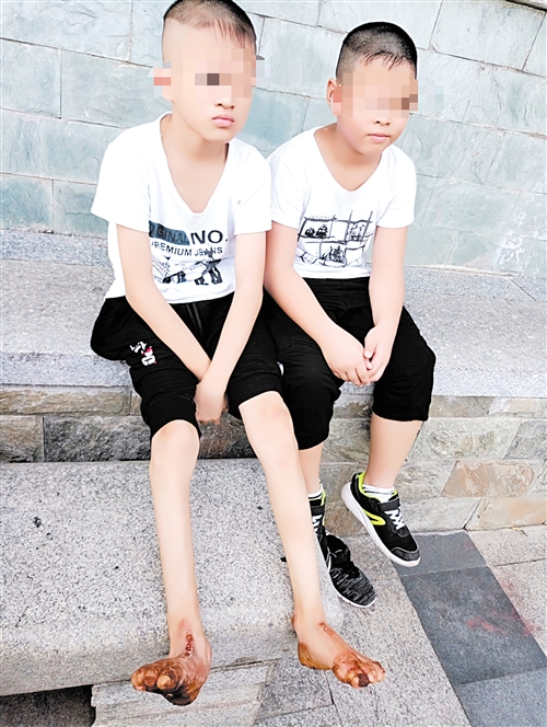 5岁脸部毛周角化症怎么治疗,2岁宝宝皮肤角化