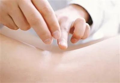 鞍山市小针刀治疗腱鞘炎,南平小针刀