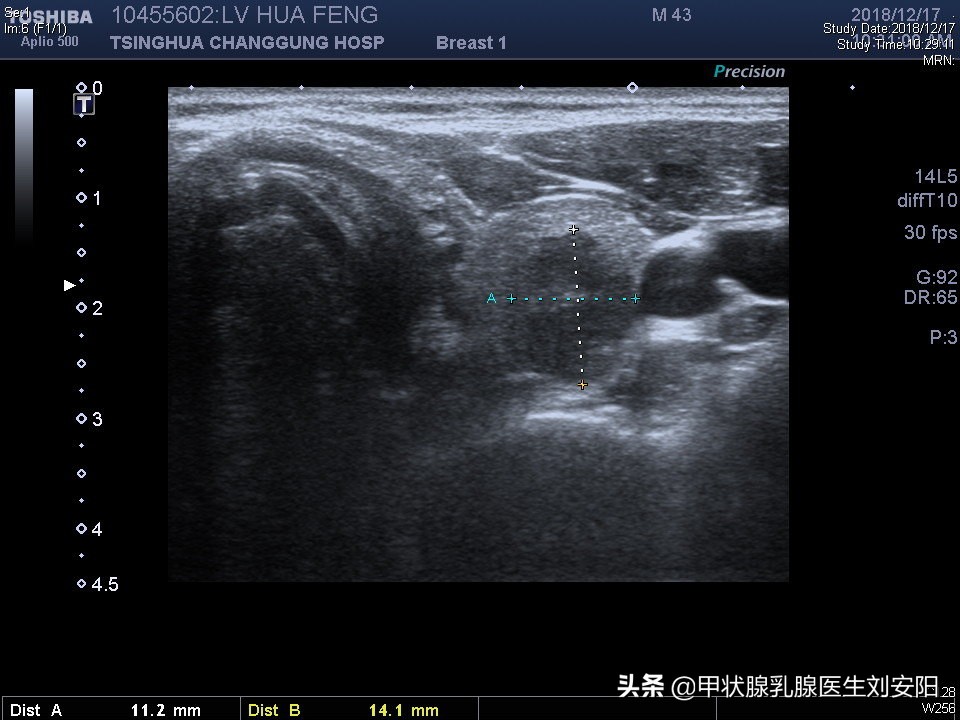 体检查出cea偏高的人多吗,体检cea指标升高是什么原因