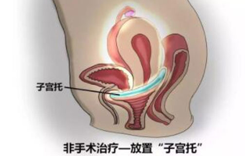 难以启齿,她每次排便需要把手伸入阴道,医生说这是病得治