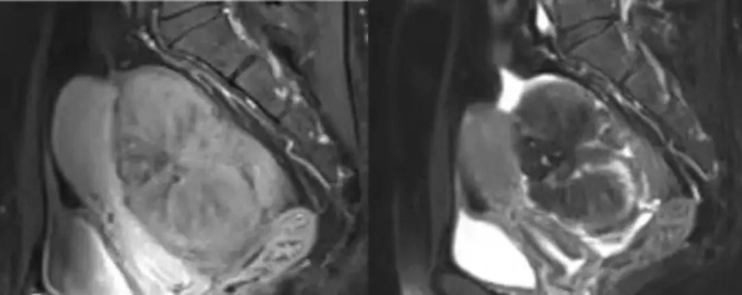 卵巢原发肿瘤的分析思路