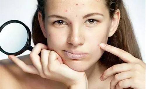 脸上痘痘除不尽,总是“春风吹又深”,这样做让你脸上痘痘去无踪