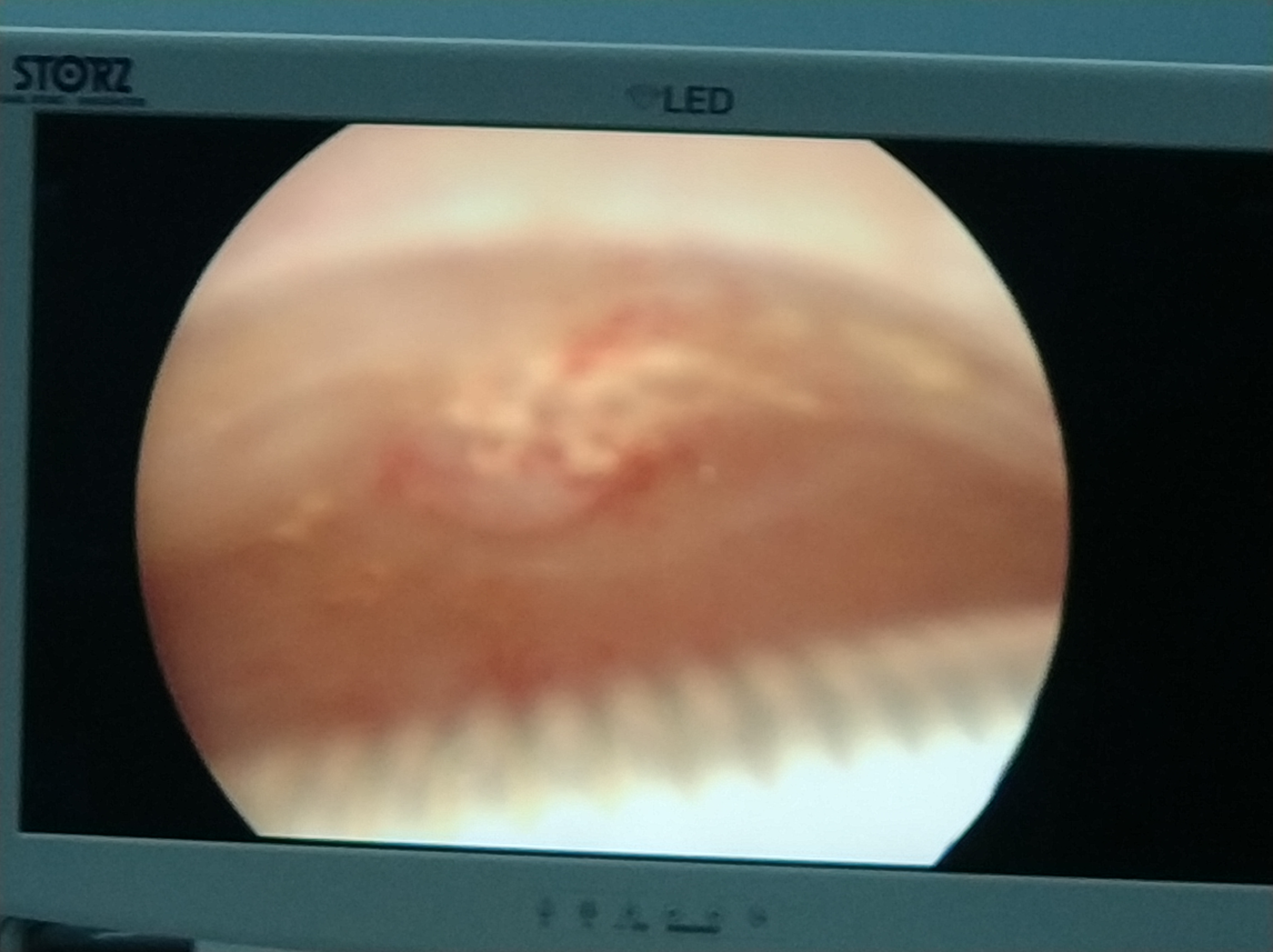 绝经后出血宫腔积液,绝经后尿路感染会引起出血吗