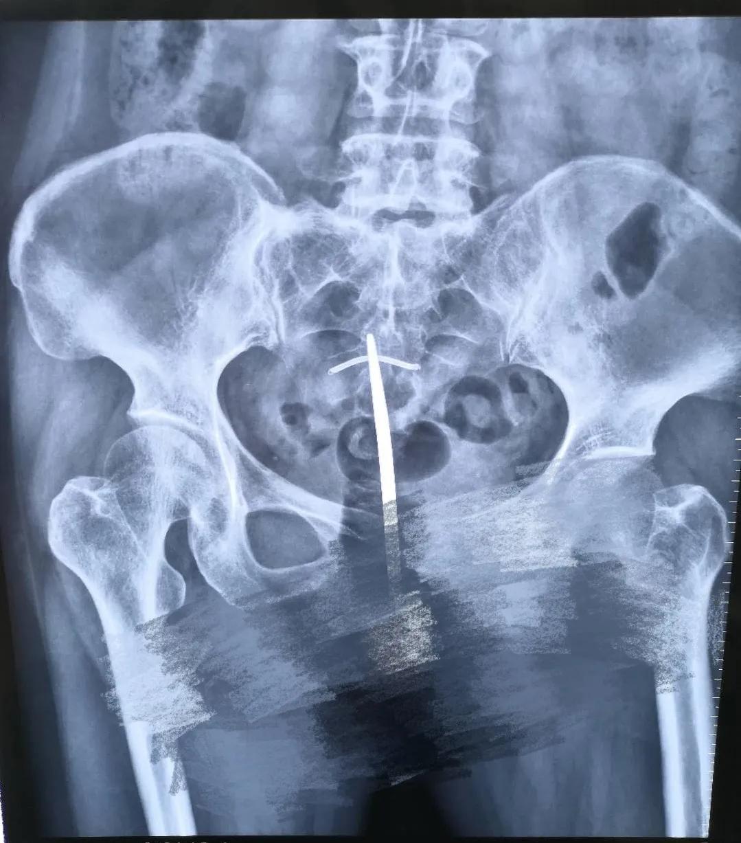 亳州市妇幼保健院妇产科开展宫腔镜手术为患者排忧解难