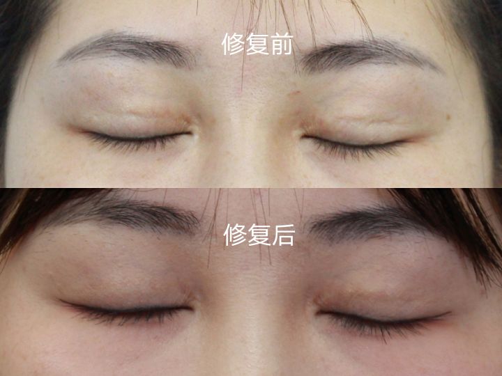 双眼皮线条凹陷疤痕怎么修复,双眼皮手术后如何避免疤痕和增生