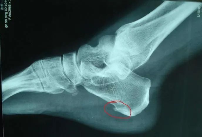 骨科康复医学科普骨刺,南阳医专一附院骨科就诊