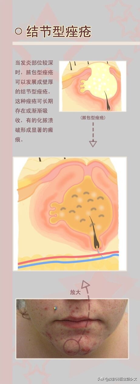 痘疮怎么治疗最快啊,身体长痘长疮怎么办最快消除