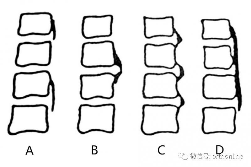 胸椎怎么做微创,脊柱内镜微创操作流程