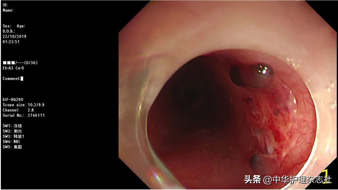 误吸患者护理的应急预案,幼童误吞电池医生顺利取出