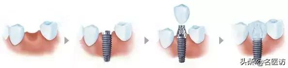 种植牙丨缺牙、补牙，你掉进这5大坑了吗？