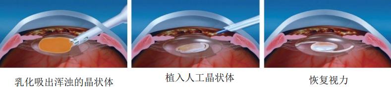 小晶体，大视界这家企业为无数患者带来光明