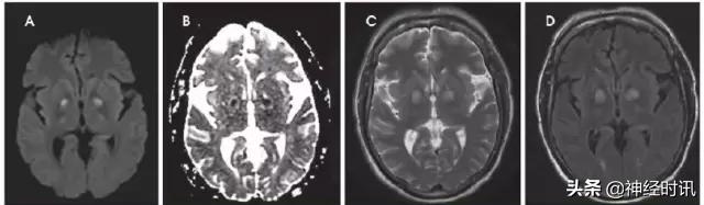 脑卒中的快速识别ppt,脑卒中神经影像学实例解析