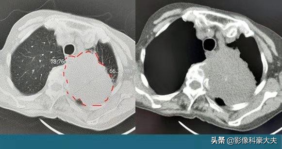 肺癌怎样才算局部晚期症状,肺癌分几种类型怎么吃药