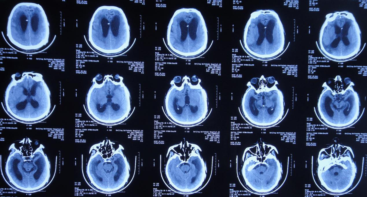 颅脑外伤术后脑积水,脑外伤脑积水颅骨缺失