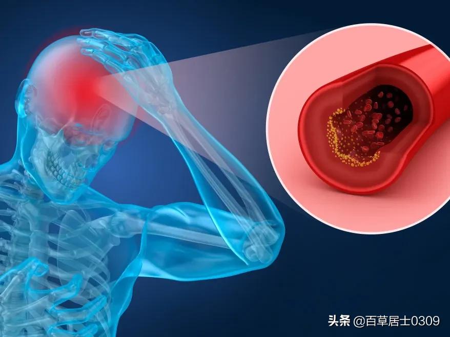 h型高血压叶酸怎么吃,h型高血压可以停药吗