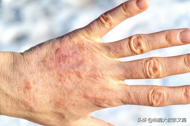 新丨南方人最惧怕的皮肤问题居然是在北方搓澡？