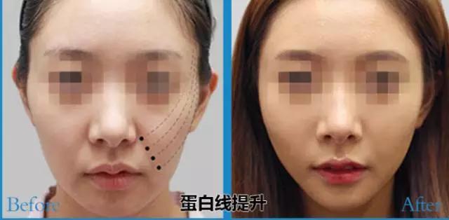 什么是线雕图片,什么是线雕线雕效果怎么样