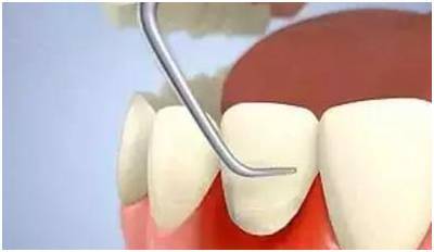 治疗它只要100多块，那为什么它却是口腔的“不治之症”？