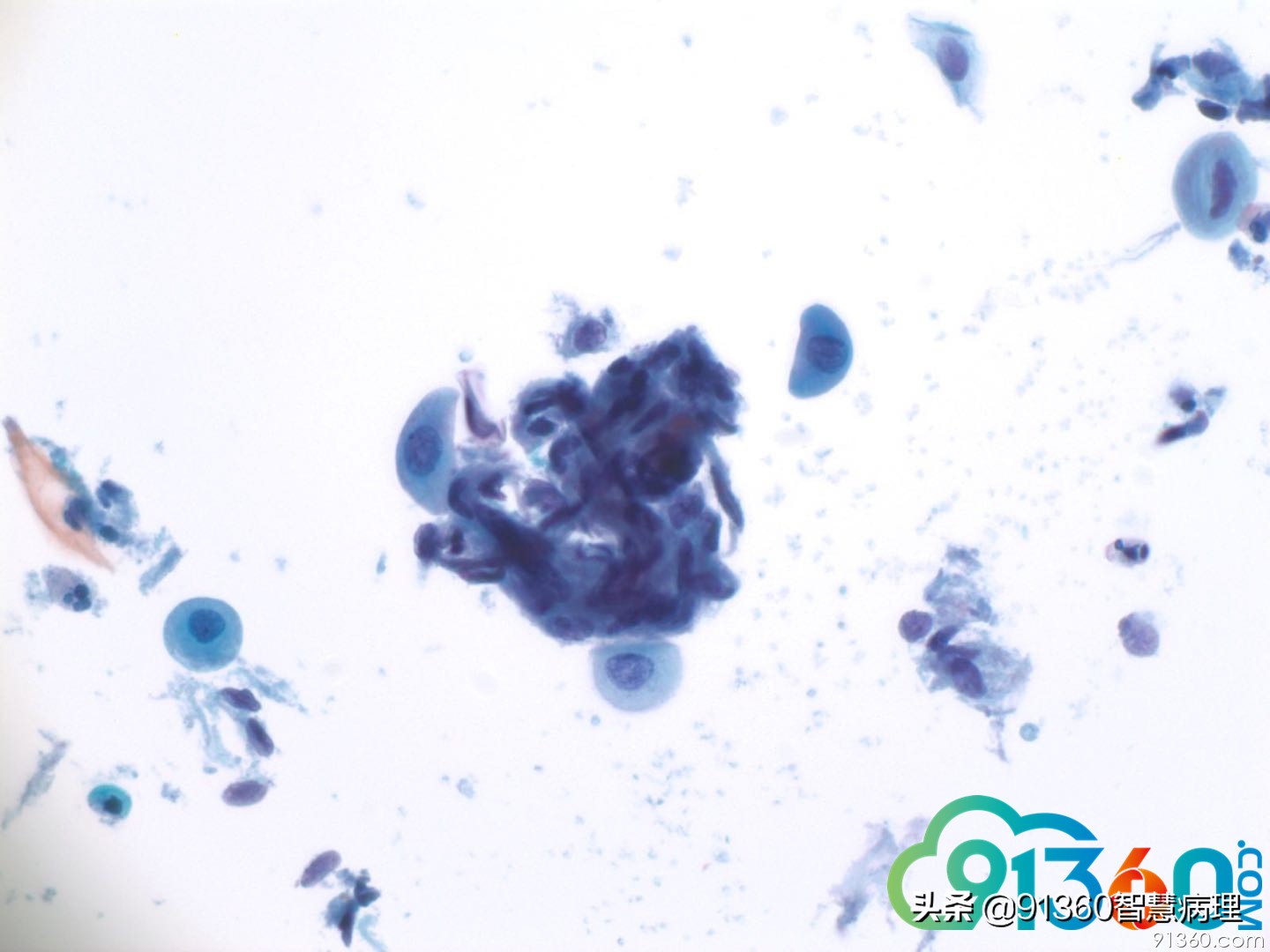 宫颈病理tct是什么检查,tct出现ascus会是宫颈癌吗