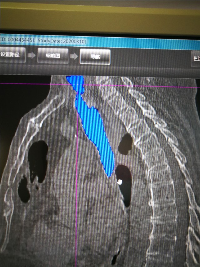 经支气管镜球囊扩张治疗气道狭窄,支气管镜球囊扩张操作视频