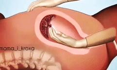 胎盘滞留子宫有什么后果,胎盘剥离不全为什么导致胎盘滞留