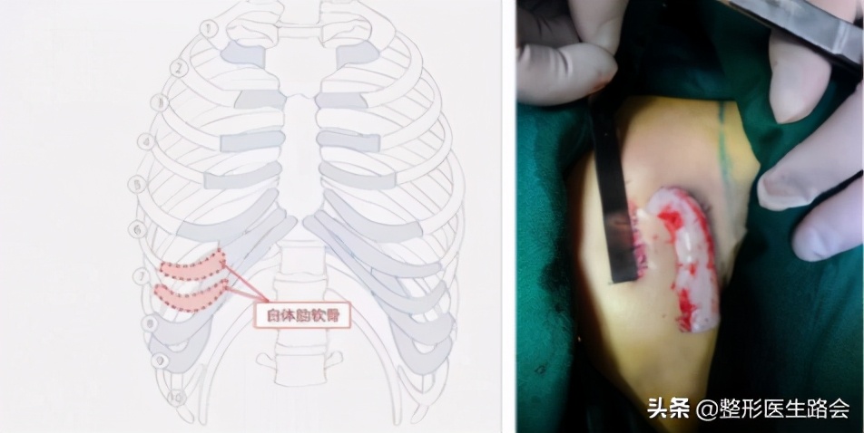 眼综合加鼻综合局麻还是全麻,鼻综合局麻和全麻哪个更肿胀