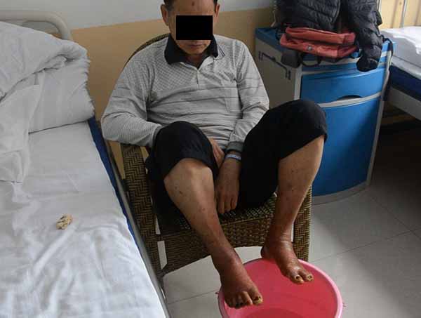 双脚发热发烫,双脚发热是什么病的前兆