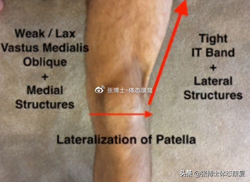 运动康复膝关节疼痛解决,下髌骨关节疼痛综合征